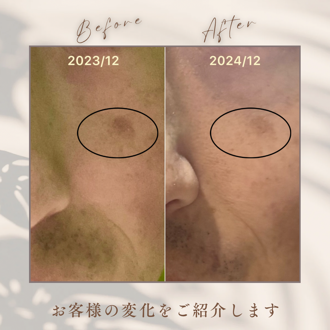 シミケア】IPL照射の1年間の変化！シミケアと脱毛の効果を比較 - Not